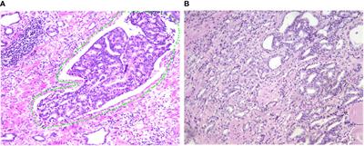 Preoperative red cell distribution width is associated with postoperative lymphovascular invasion in prostate cancer patients treated with radical prostatectomy: A retrospective study